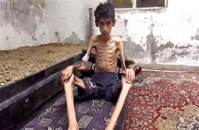 Madaya is Another Auschwitz Without the Ovens